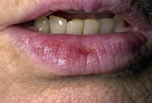 Featured image of post Skin Cancer On Lips Pictures